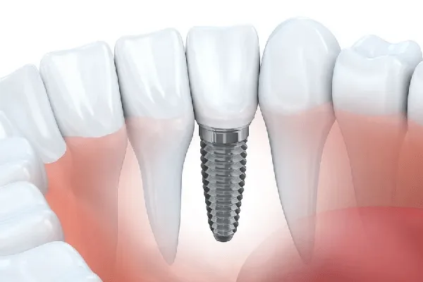 Cosmetic dentistry services in Carmarthen