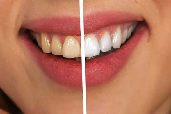 Professional tooth whitening treatment